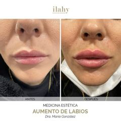 Aumento de labios - Ilahy Instituto Dermoestético