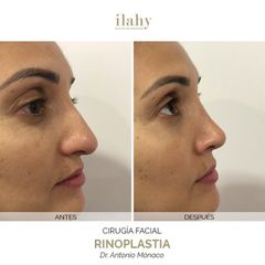 Rinoplastia - Ilahy Instituto Dermoestético