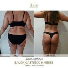 Balón gástrico - Ilahy Instituto Dermoestético