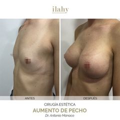 Aumento de pecho - Ilahy Instituto Dermoestético