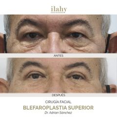 Blefaroplastia - Ilahy Instituto Dermoestético