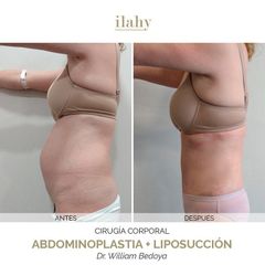 Abdominoplastia + Liposucción - Ilahy Instituto Dermoestético