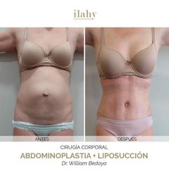 Abdominoplastia + Liposucción - Ilahy Instituto Dermoestético