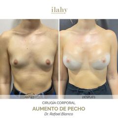 Aumento de pecho - Ilahy Instituto Dermoestético