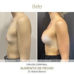 Aumento de pecho - Ilahy Instituto Dermoestético
