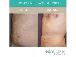 Liposucción - Dra. Marta Payá