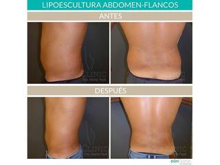 Lipoescultura - Dra. Marta Payá