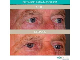 Blefaroplastia - Dra. Marta Payá