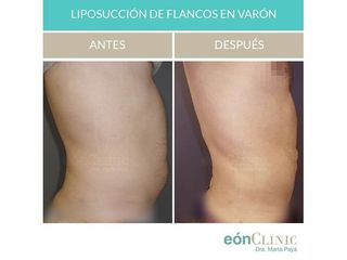 Liposucción - Dra. Marta Payá