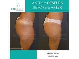 Lipoláser - Dra. Marta Payá