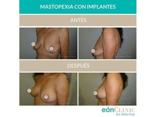 Mastopexia - Dra. Marta Payá