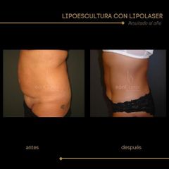 Lipoescultura - Dra. Marta Payá
