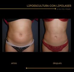 Lipoescultura - Dra. Marta Payá
