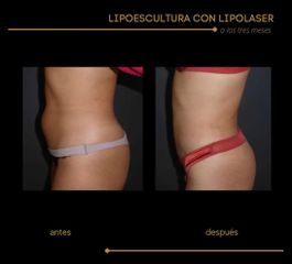 Lipoescultura - Dra. Marta Payá