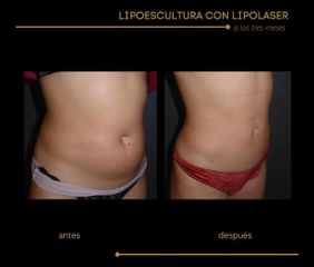 Lipoescultura - Dra. Marta Payá