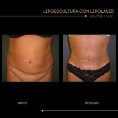 Lipoescultura - Dra. Marta Payá