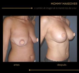 Lipoescultura - Dra. Marta Payá