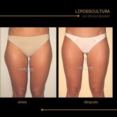 Lipoescultura - Dra. Marta Payá