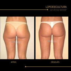 Lipoescultura - Dra. Marta Payá