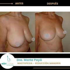 Mastopexia - Dra. Marta Payá