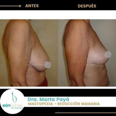 Mastopexia - Dra. Marta Payá