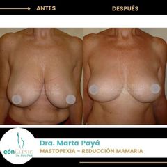 Mastopexia - Dra. Marta Payá