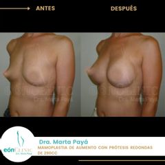 Aumento de pecho - Dra. Marta Payá
