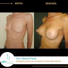 Aumento de pecho - Dra. Marta Payá