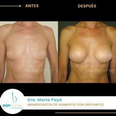 Aumento de pecho - Dra. Marta Payá