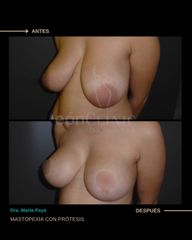 Mastopexia - Dra. Marta Payá