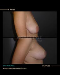 Mastopexia - Dra. Marta Payá
