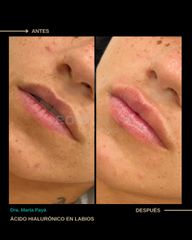 Aumento de labios - Dra. Marta Payá