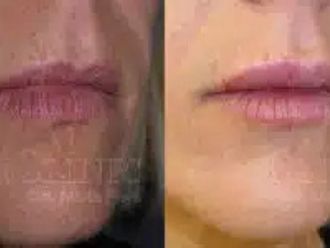 Aumento labios antes y después - 871783