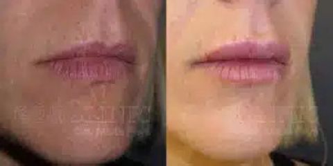 Dra Marta Paya eonclinic aumento de labios