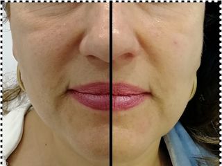 Antes y después Biorremodelacion facial 