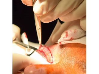 Blefaroplastia - 639719