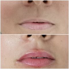 Antes y después Aumento de labios - Dra. Lucía Zamudio Sánchez