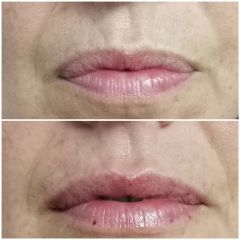 Antes y después Aumento de labios - Dra. Lucía Zamudio Sánchez