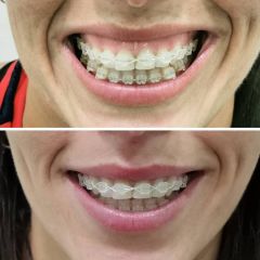 Antes y después sonrisa gingival- Dra. Lucía Zamudio Sánchez