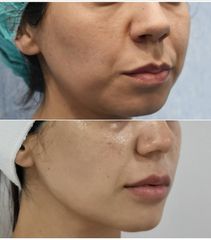 Antes y después Bichectomía - Dra. Lucía Zamudio Sánchez