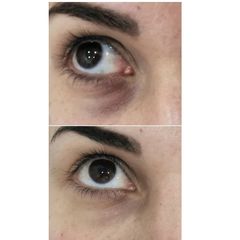 Antes y después Eliminación de ojeras - Dra. Lucía Zamudio Sánchez