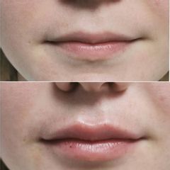 Aumento de labios - Dra. Lucía Zamudio Sánchez