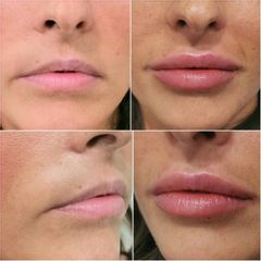 Aumento de labios - Dra. Lucía Zamudio Sánchez