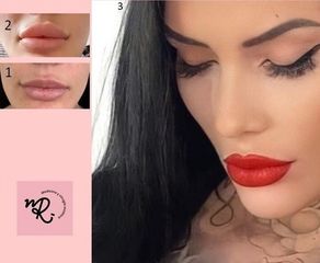 Lipofilling - Nikki Reina