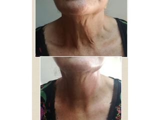 Rejuvenecimiento de cuello con plasmapen - Nikki Reina