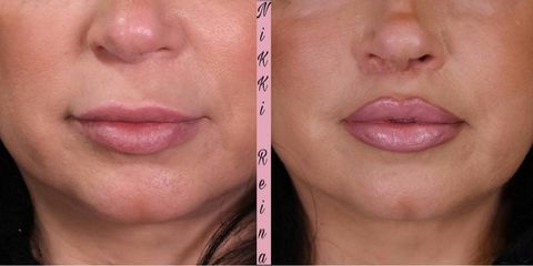 Aumento de labios - Nikki Reina