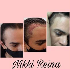 Tratamiento capilar - Liposucción - Nikki Reina