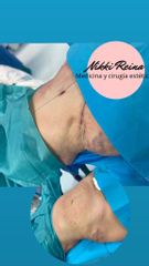 Abdominoplastia - Nikki Reina