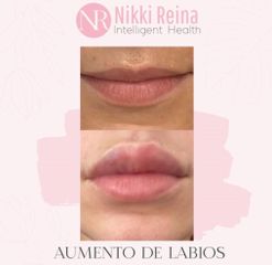 Aumento de labios - Nikki Reina