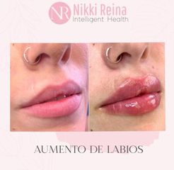 Aumento de labios - Nikki Reina
